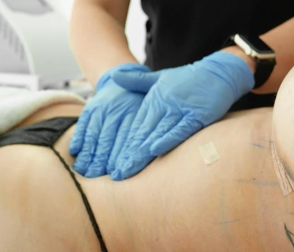 Drainage Lymphatique post-opératoire